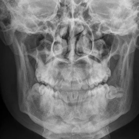 X-ray Mandible PA View